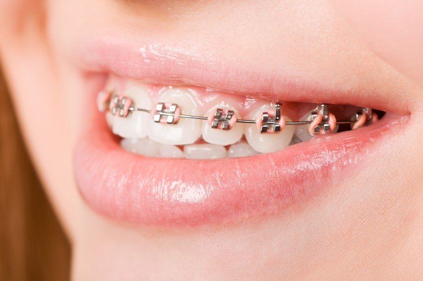découvrez notre comparatif des meilleures mutuelles orthodontie 2025 : conseils, garanties, remboursements et astuces pour choisir la complémentaire idéale pour vos besoins dentaires.